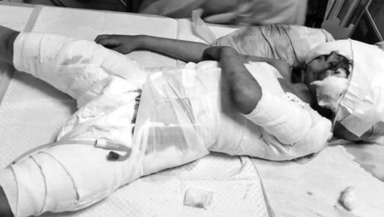 Child bit by stray dogs in Larkana breaths his last
