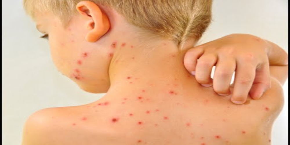 Chickenpox