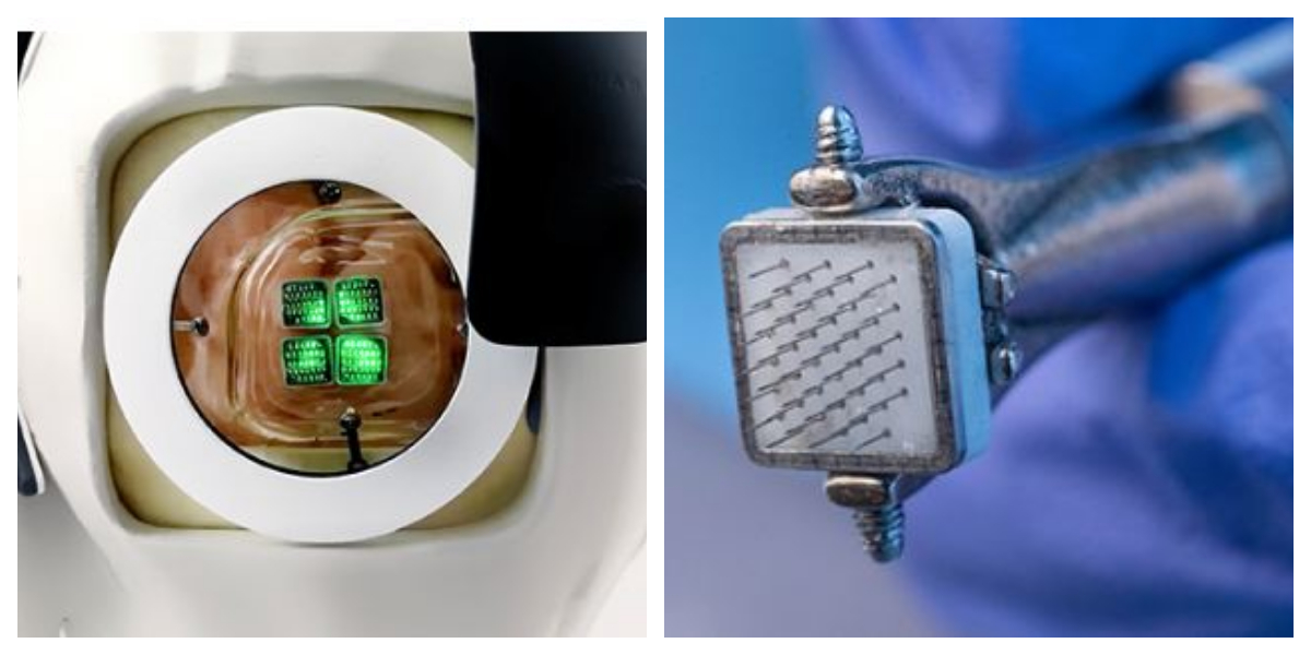 Testing of World's First Vision Restoration Device On Humans