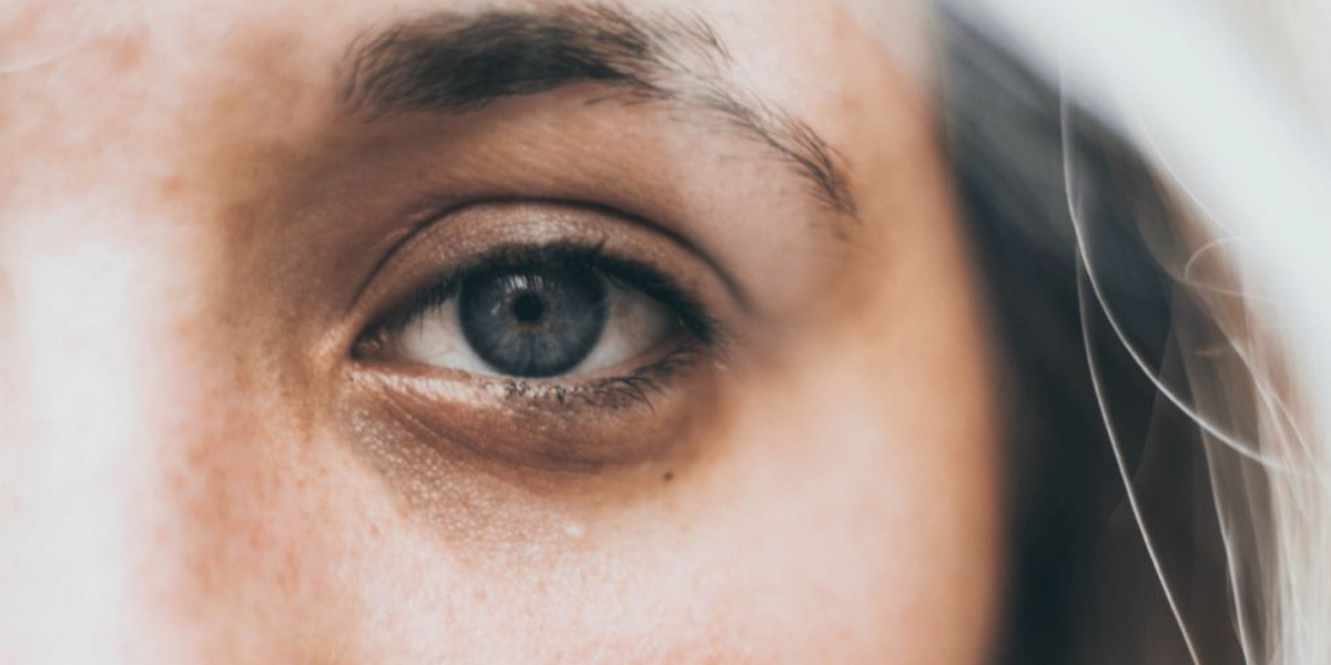 Dark Circles home remedies