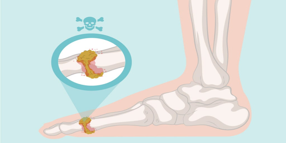 Natural Remedies To Control Uric Acid In The Body
