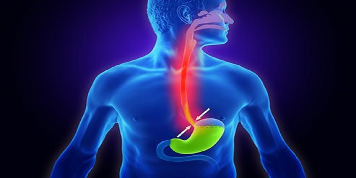 How to avoid Acid Reflux and Heartburn with lifestyle changes