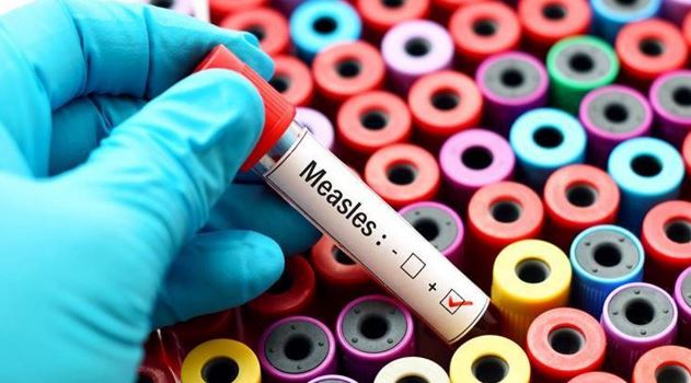 measles