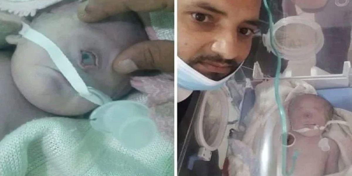 one-eye baby