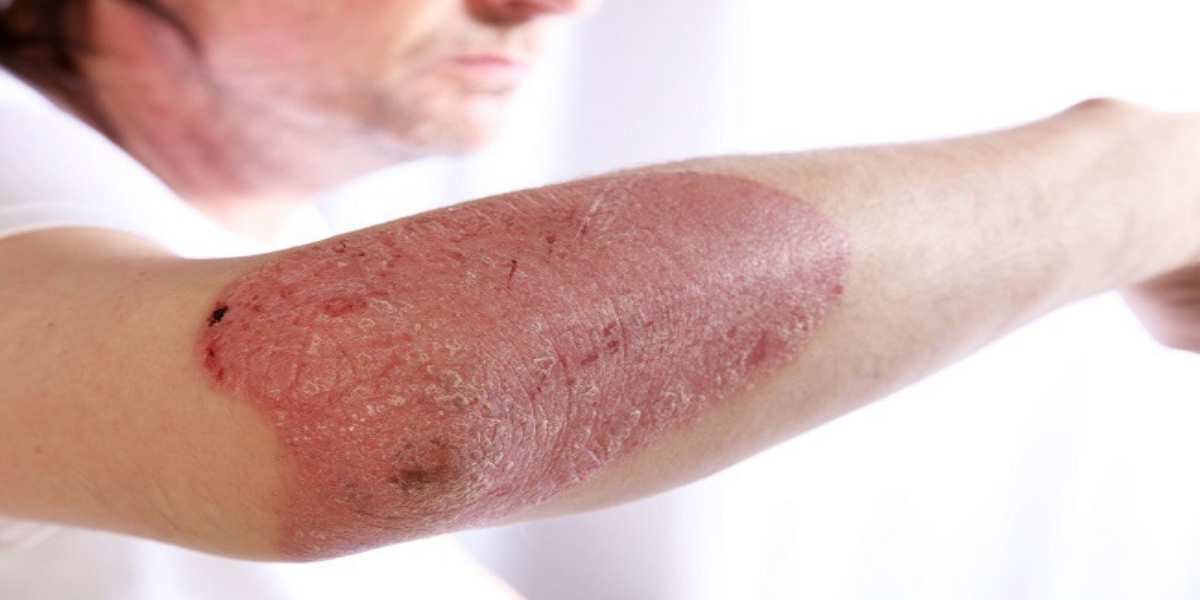 skin cancer