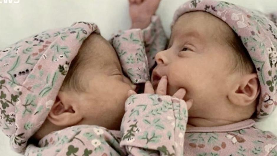 conjoined twins
