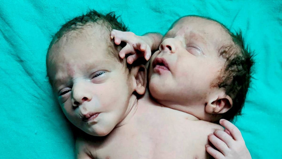 Baby born two heads