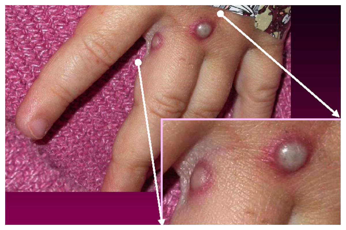 monkeypox virus