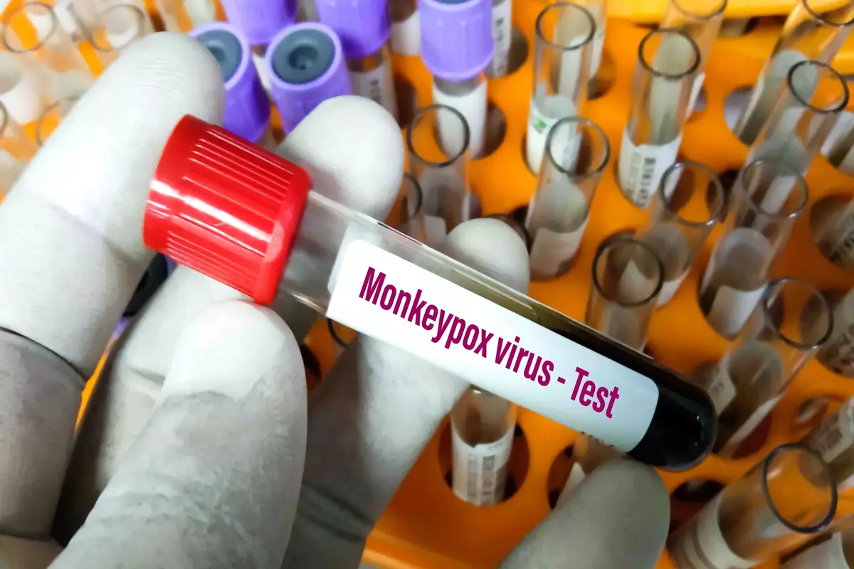 monkey pox in South Florida rises
