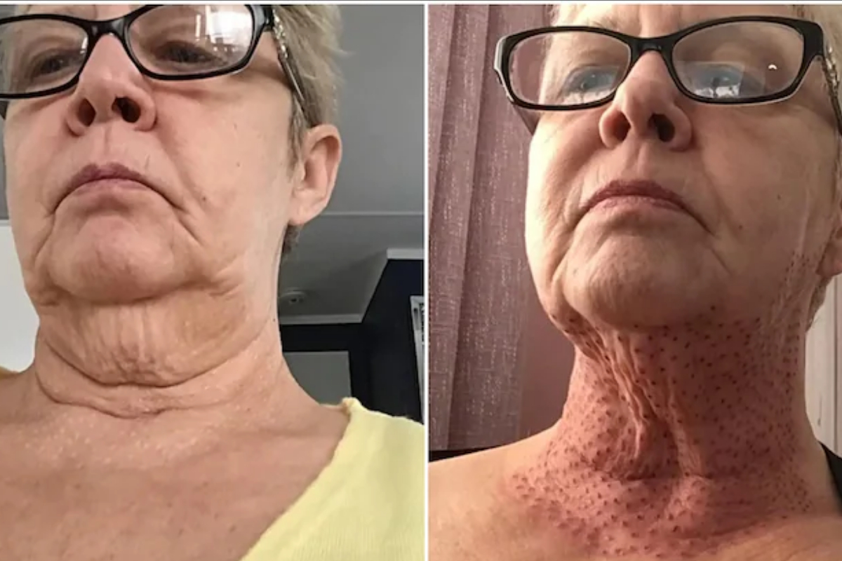 Skin-tightening operation