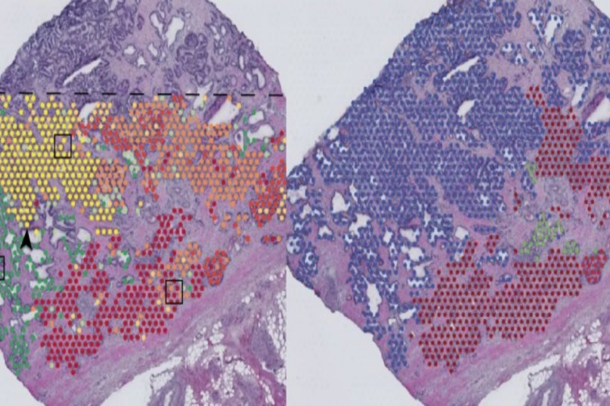 Cancer growth exposed