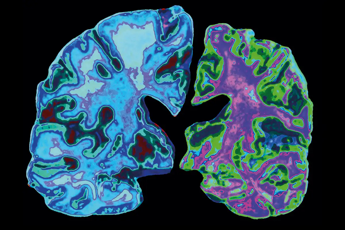 Alzheimer's drug