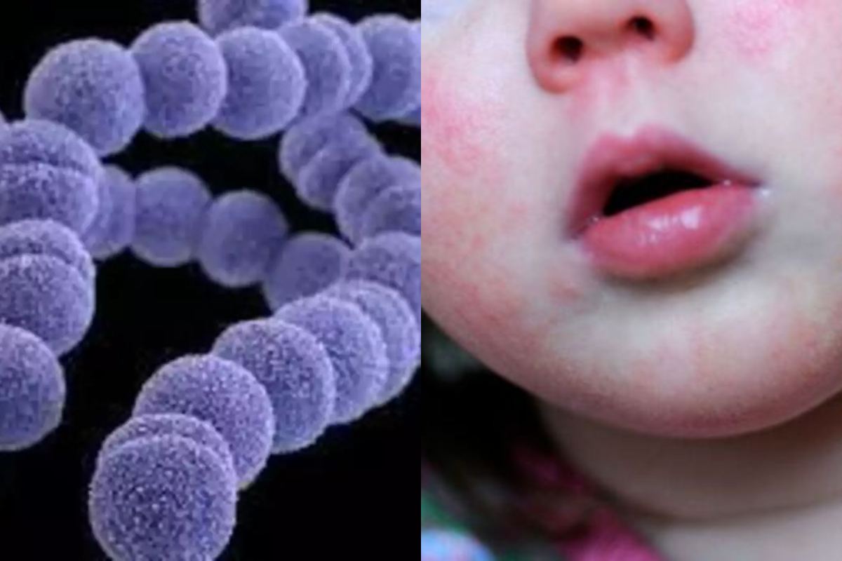 Strep A