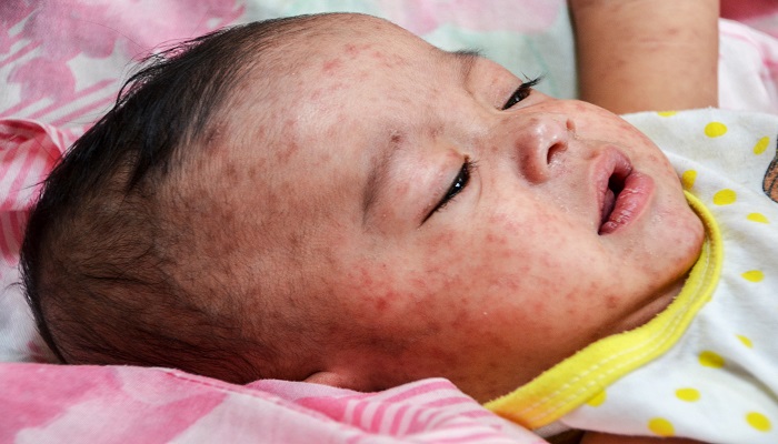 measles in Lasbela district