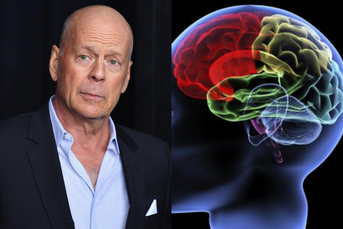 frontotemporal dementia