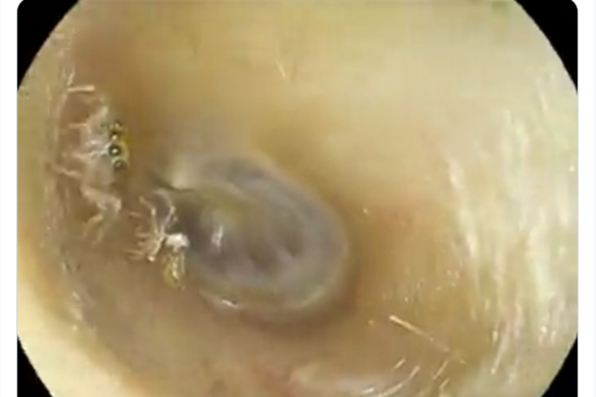 Spider in Ear