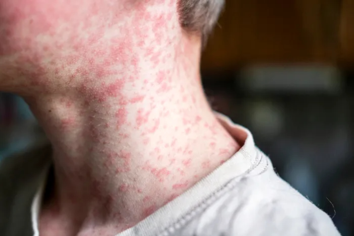 Measles cases surge in Karachi and Sindh