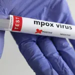 Smart lockdown imposed in Jamrud amid Mpox outbreak