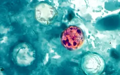 Cyclosporiasis cases in Michigan surpass 10,000