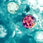 Cyclosporiasis cases in Michigan surpass 10,000
