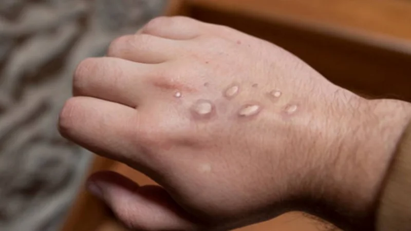 Pakistan reports first case of Monkeypox in 2025