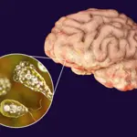 Naegleria Fowleri claims woman life in Karachi