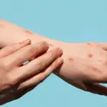 US confirms first case of more aggressive mpox strain