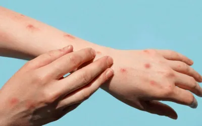 New mpox case reported in Peshawar