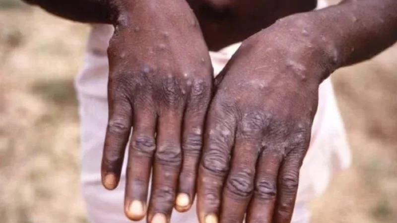 Another monkeypox
