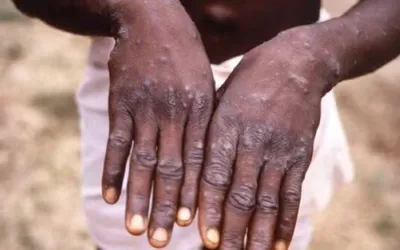 Another monkeypox patient detected in Karachi