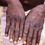 Another monkeypox patient detected in Karachi