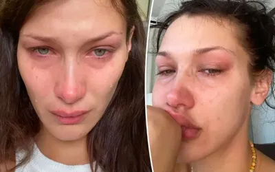 Bella Hadid speaks about painful health struggles and daily life