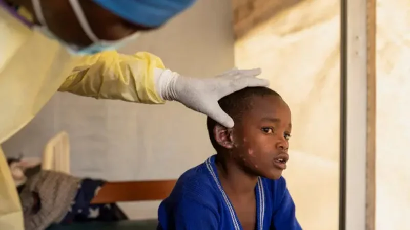 WHO grants approval for first Mpox vaccine to strengthen disease control in Africa