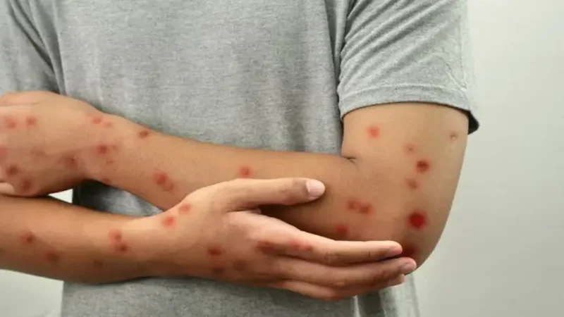 21 monkeypox cases reported in six months at Mayo Hospital Lahore