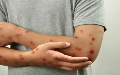 21 monkeypox cases reported in six months at Mayo Hospital Lahore
