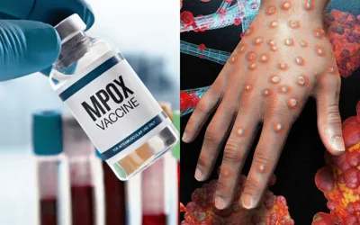 Alert; India reports first case of mpox