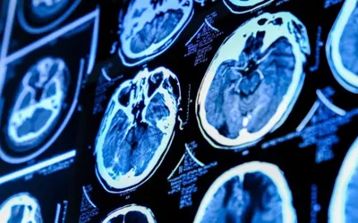 Blocked brain pathways may hint at early Alzheimer’s