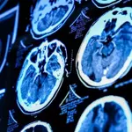 Blocked brain pathways may hint at early Alzheimer’s