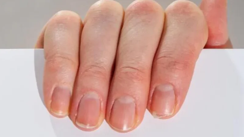 Nail colour changes