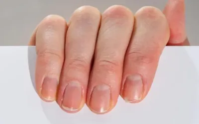 Nail colour changes may signal hidden health problems