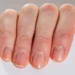 Nail colour changes may signal hidden health problems