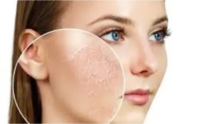Cold weather and dull skin: causes, effects, and natural solutions