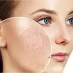 Cold weather and dull skin: causes, effects, and natural solutions