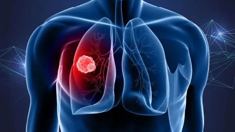 Lung cancer deaths in China to reach 760,000 by 2030 - lung cancer