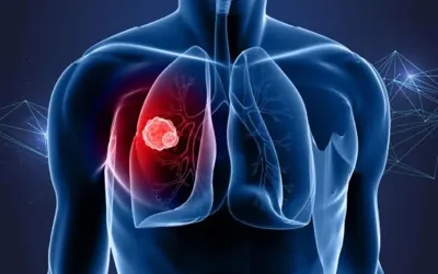 Lung cancer deaths in China to reach 760,000 by 2030