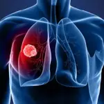 Lung cancer deaths in China to reach 760,000 by 2030