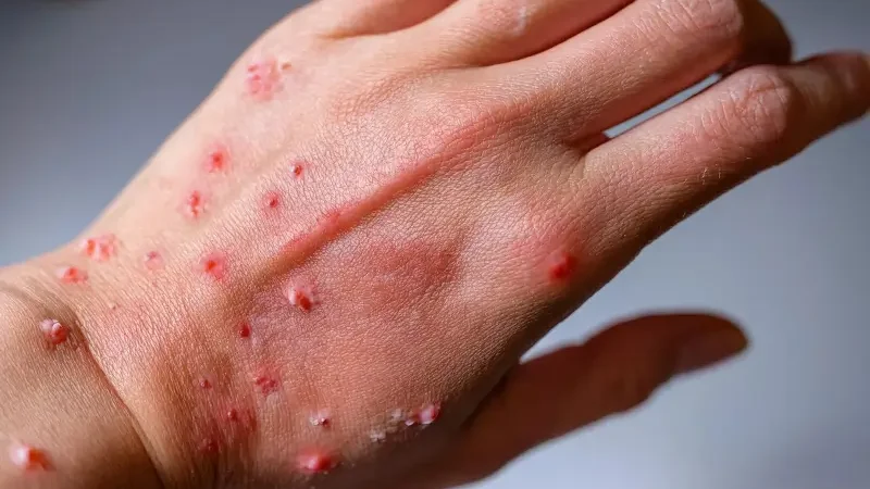 Mpox case confirmed in Karachi: Alert issued by Sindh