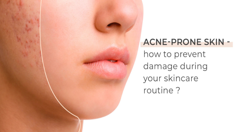 Acne in summer