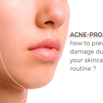 Summer Acne: How to tackle sweat, oil, and pollution?