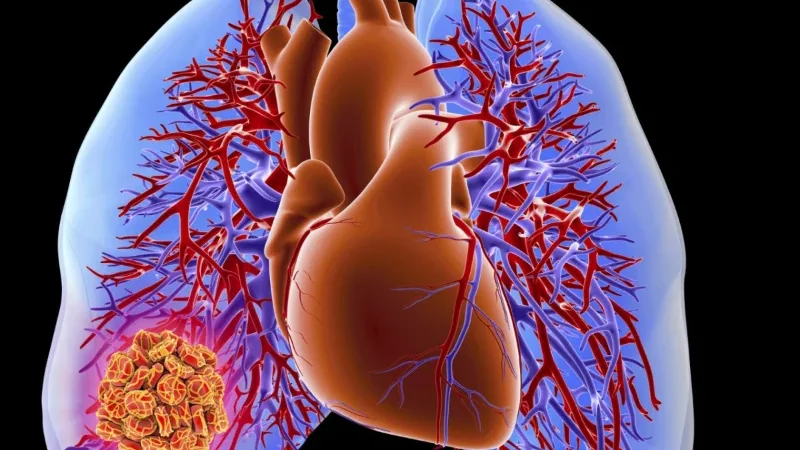 Pulmonary embolism